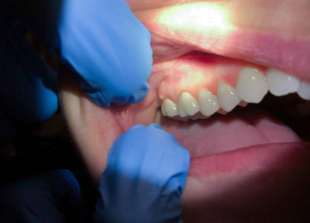 Best Emergency Tooth Extraction in Murphy, NC