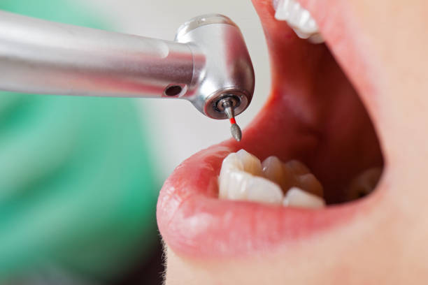 Best Emergency Tooth Extraction in Murphy, NC